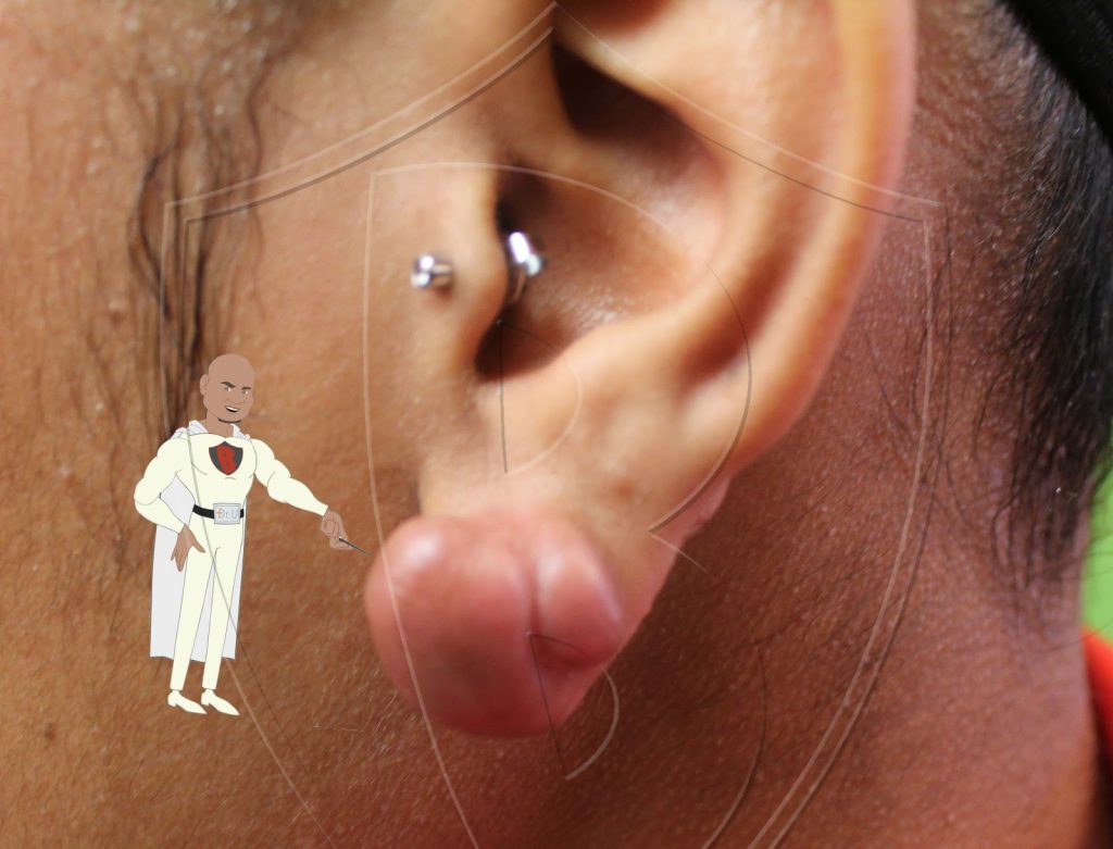 Keloid scar growth on patient's earlobe