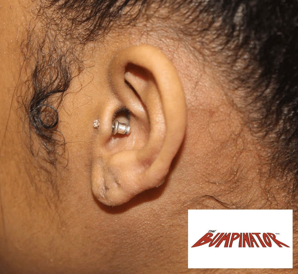 Front view of patient's left hair shows the remarkable healing of both the keloid excisional wound and the final reconstructed shape of her earlobe