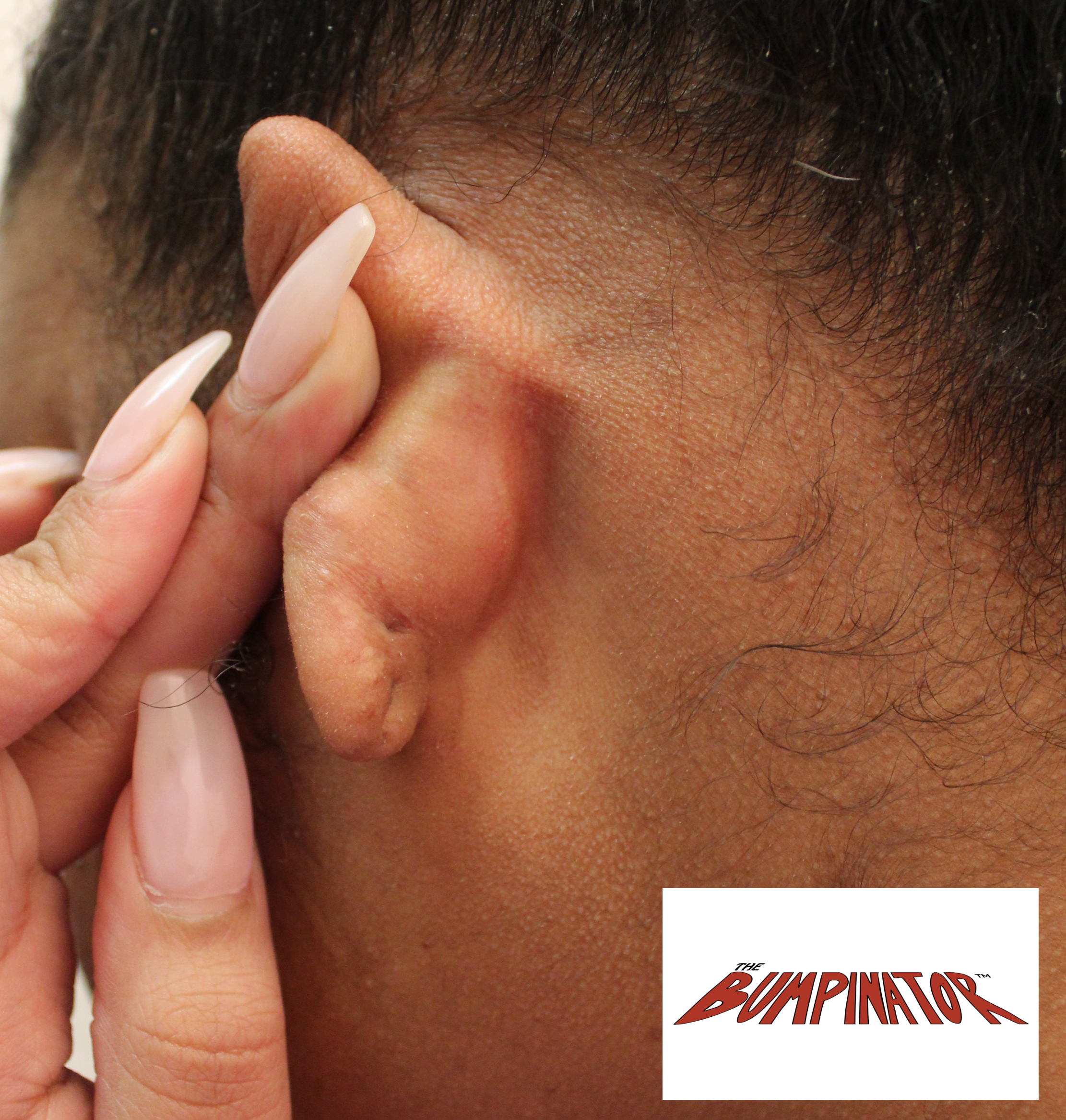 Follow up photo depicts the back view of patient's left ear which has been restored in an excellent fashion