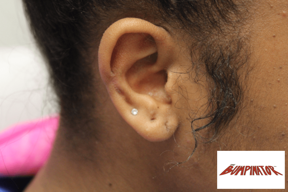 Kidney-shaped keloid bump is no longer present on patient's right ear, thanks to Dr.Bumpinator's advanced surgical techniques