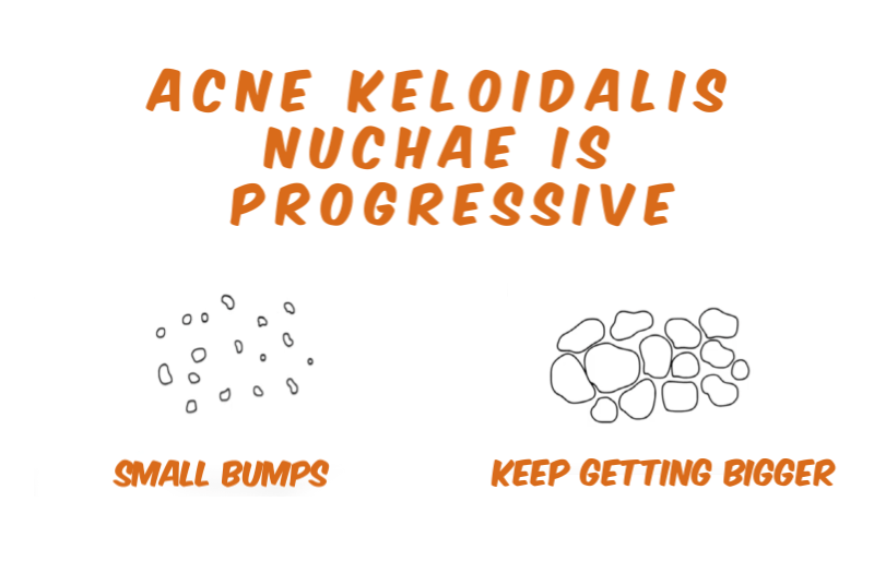 AKN Bumps Grow and Fuse Together - Graphic Image Detailing Acne Keloidalis Nuchae Progression.