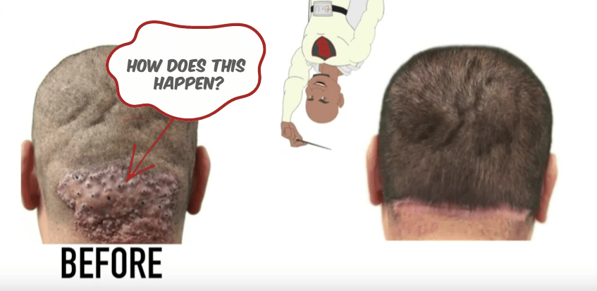 What one person may misunderstand as small razor bumps on the back of the head, can potentially be AKN, and can grow to this stage if left untreated. It is important to understand how Acne Keloidalis Nuchae develops as a patient, as this can help you understand the procedure and steps required to remove AKN better.