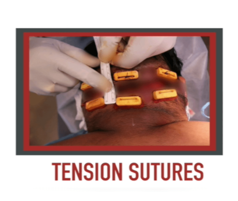 Dr. Bumpinator's Tension Sutures for AKN