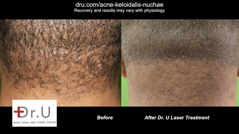 Patient before and after AKN treatment with laser