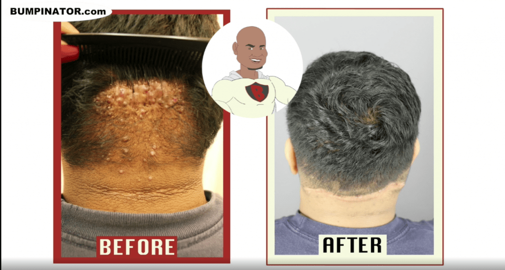 Before and After AKN Type 2 | Dr.Bumpinator Patient