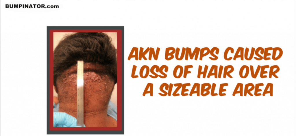Area Affected By AKN Bumps on Dr.Bumpinator's Patient