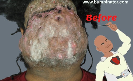 The massive Acne Keloidalis Nuchae bump before surgery.