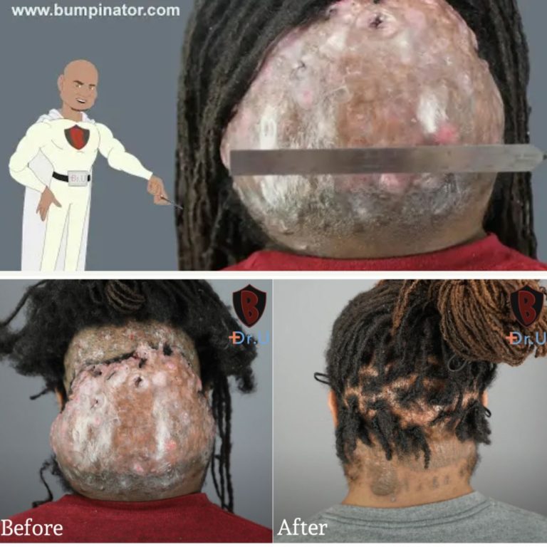 Los Angeles Man Gets Rid of Massive Bumps On The Back Of His Head Once and For All