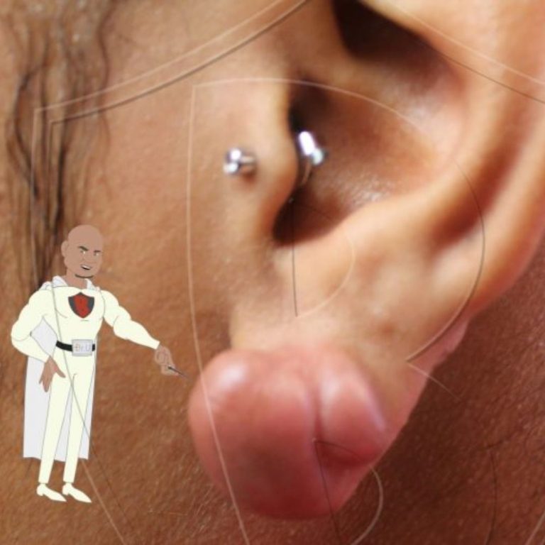 The Keloid Dilemma