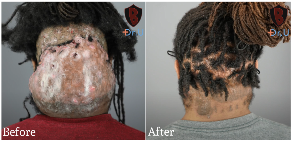 AKN removal results. before and after surgery.
