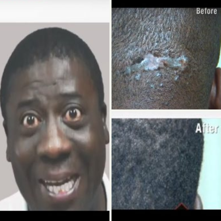Can You Tell That This Man Had AKN Surgery? See His Final Scar Outcome