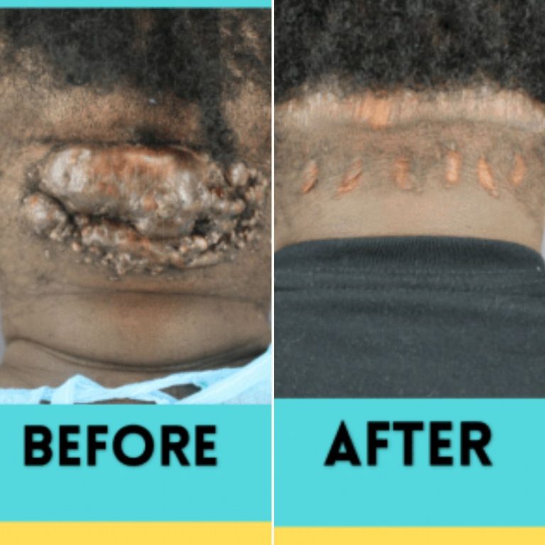 AKN Bump Removal Testimonial: Patient Can Now Rock Short Hair With No More Worries