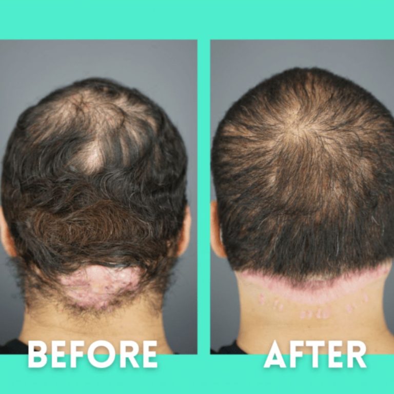 Witness One Man’s Journey in Getting Rid of Painful AKN Bumps