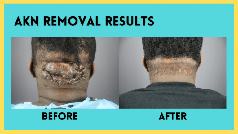 AKN Bump Removal Testimonial: Patient Can Now Rock Short Hair With No More Worries