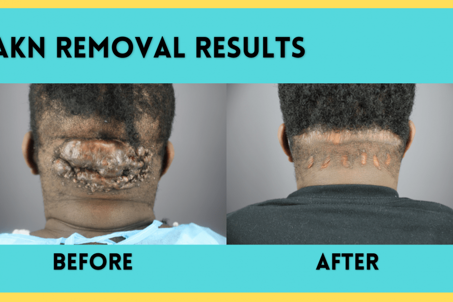 AKN Removal Results: Large Bump Removal Acne Keloidalis Nuchae Before & After Dr. U Bumpinator