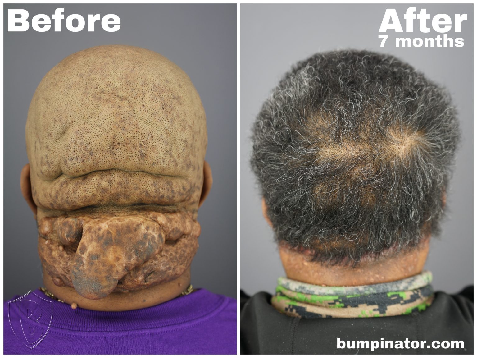 Acne Keloidalis Nuchae Surgical Laser Removal Before and After Picture