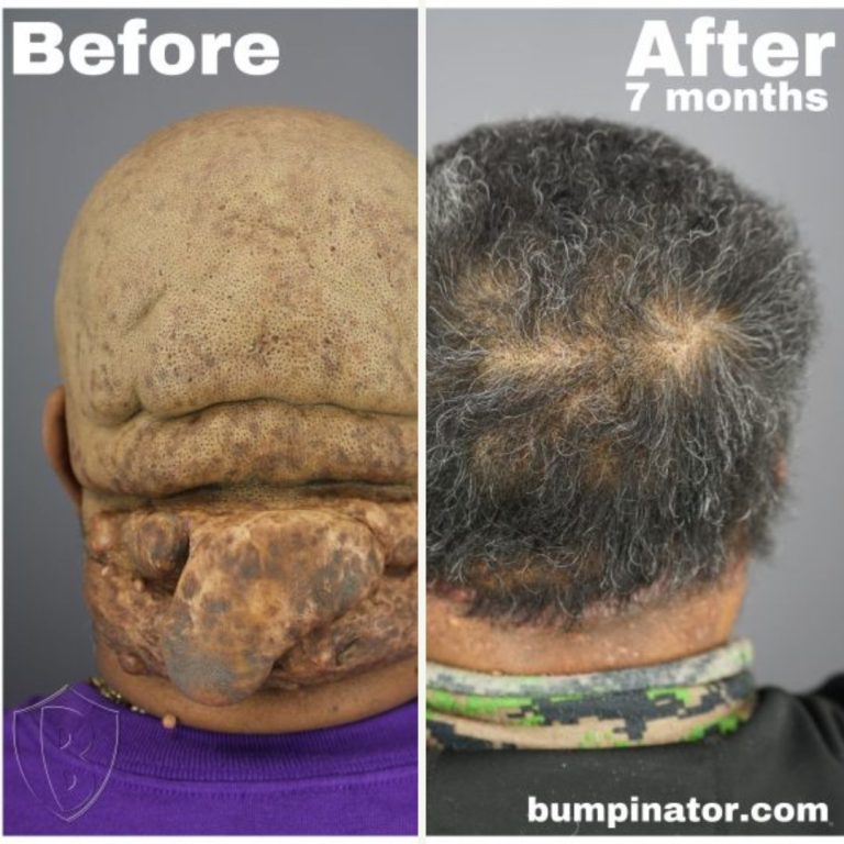 Acne Keloidalis Nuchae Surgical Laser Removal Before and After Picture Results: Major AKN Transformation in 7 Months