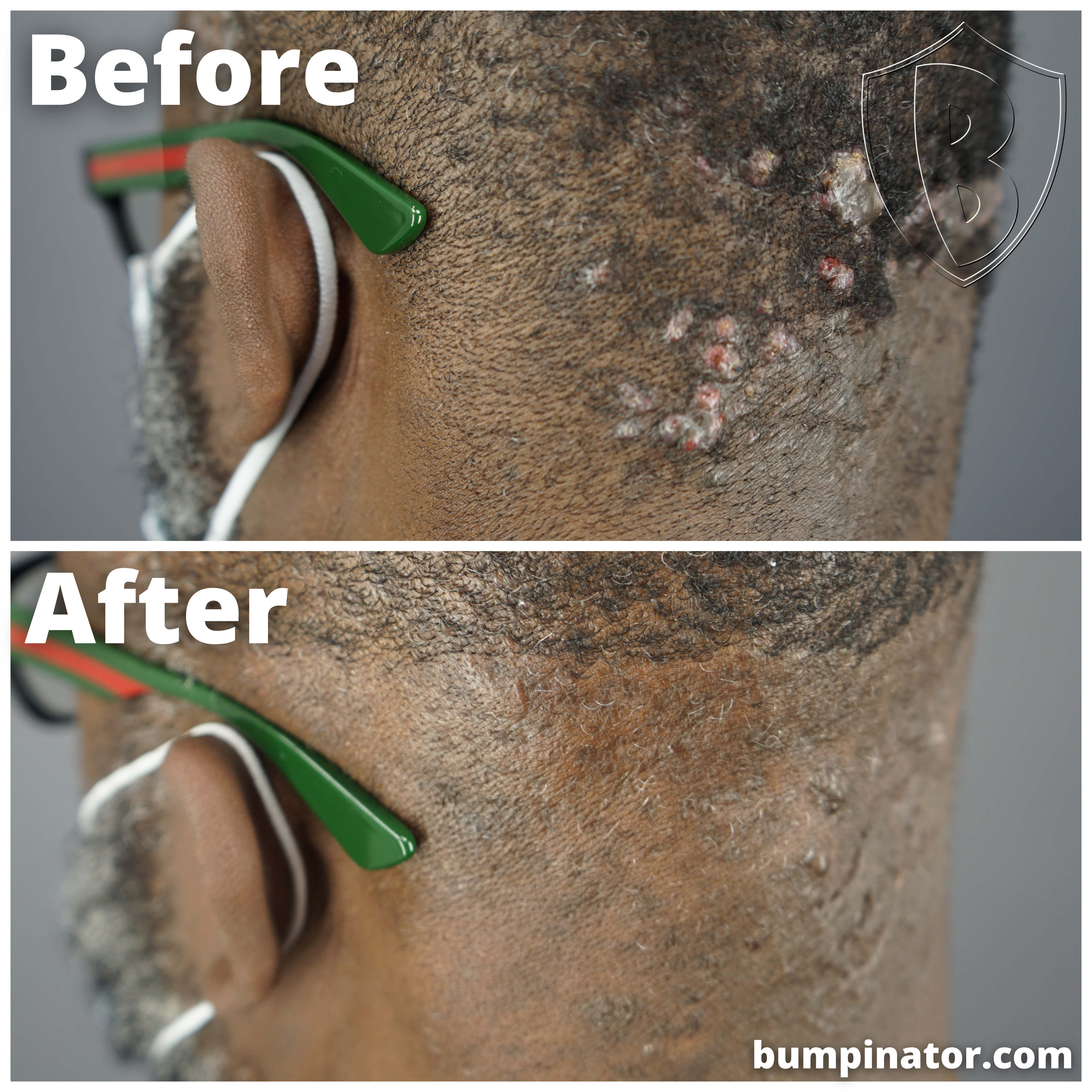 Small AKN Bumps Removal, post surgery picture results. Before & After Laser Surgery Removal Results.