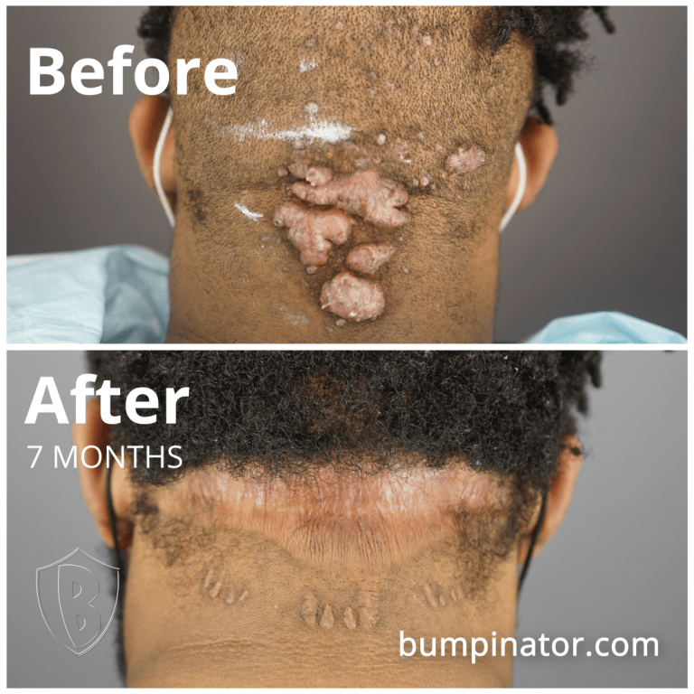 Multiple Large AKN Bumps Removal: AKN Surgery Success Before & After Results
