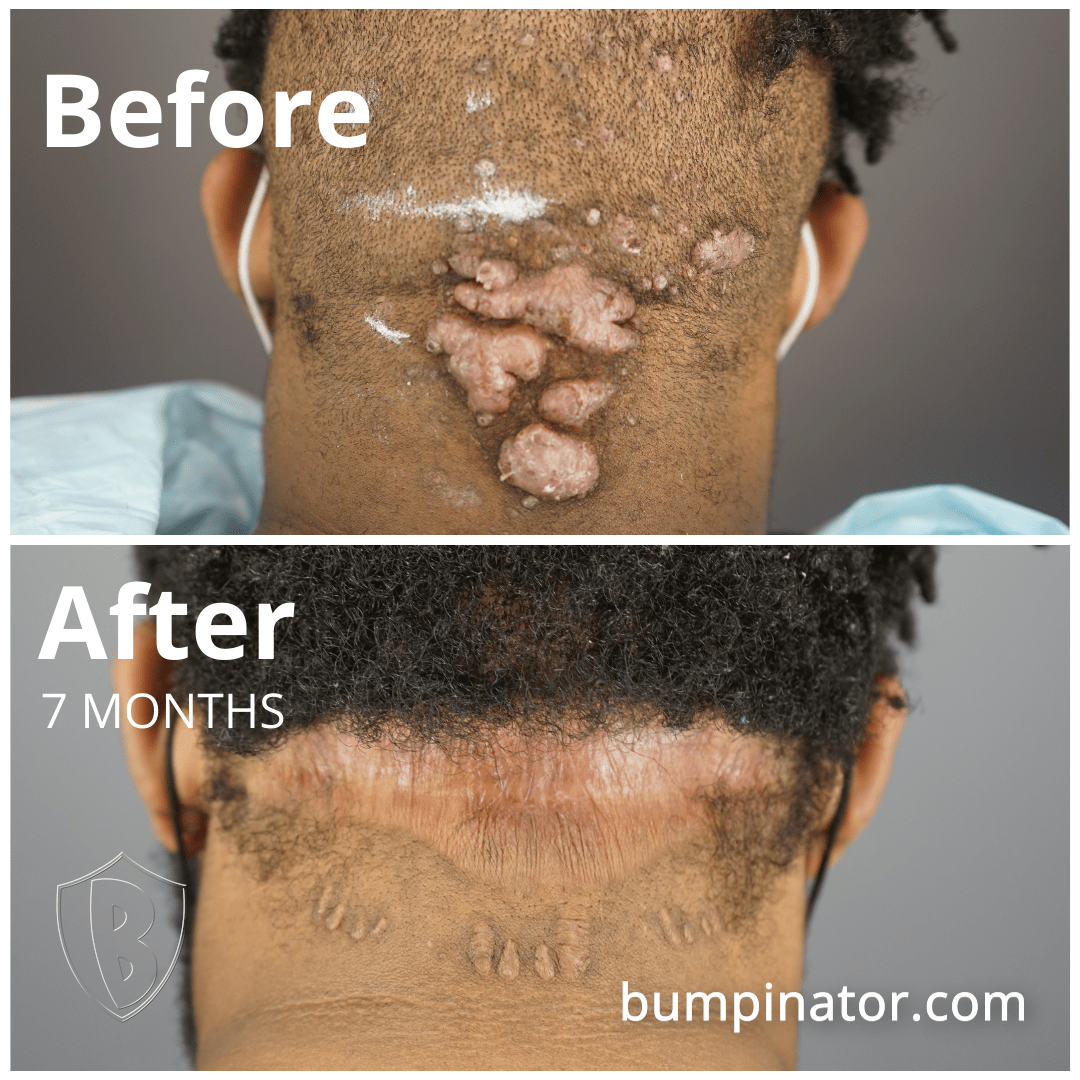 Using precise surgical methods, Dr. U AKA The Bumpinator was able to effectively remove these large AKN bumps and leave a natural-looking scar for the patient.