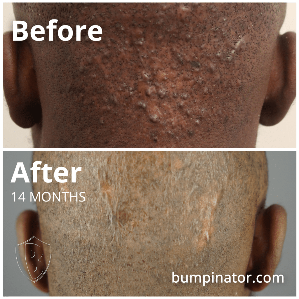 Minor AKN Acne Keloidalis Nuchae Bumps - Small barber's rash on back of head - surgery removal results.