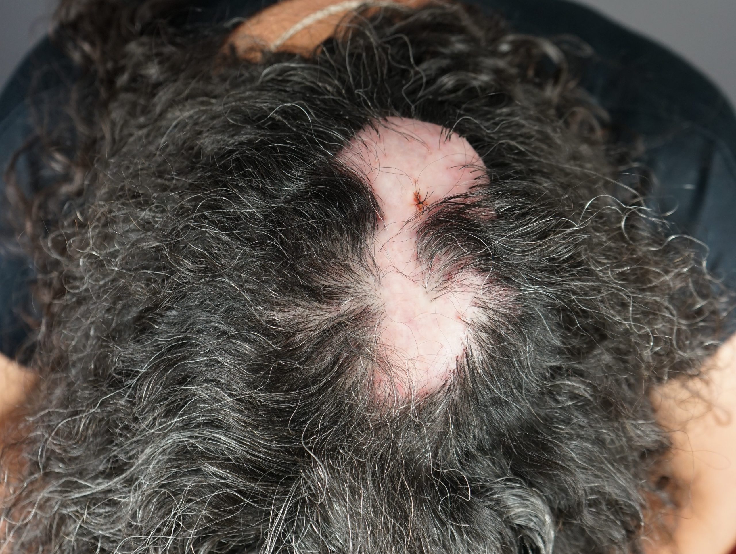 Example of Folliculitis Decalvans (FD) Patient #1 - Dr. U Skin & Hair Clinic, The Bumpinator