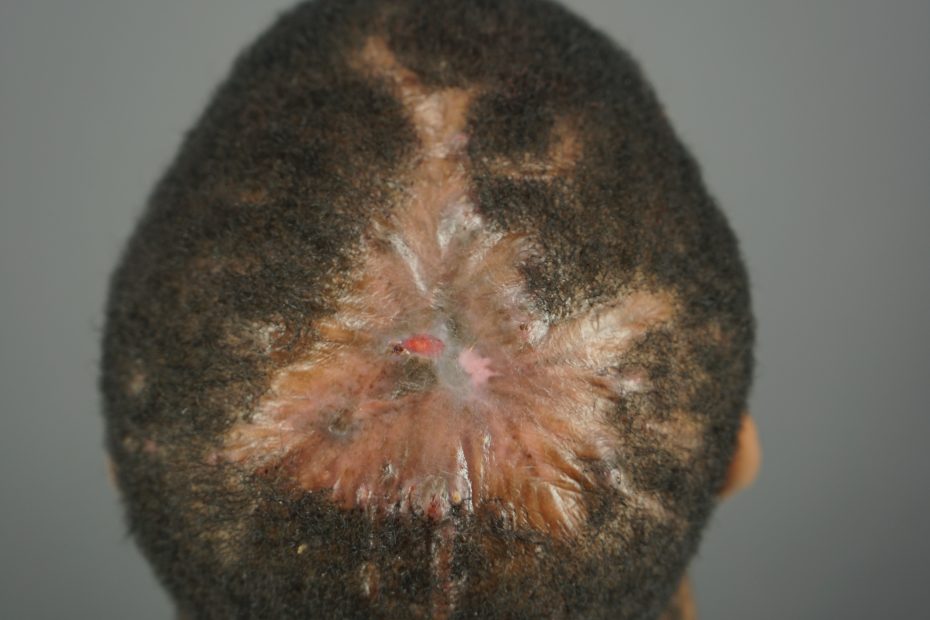FD Folliculitis Decalvans Example V1 - Dr. U Skin & Hair Clinic, The Bumpinator
