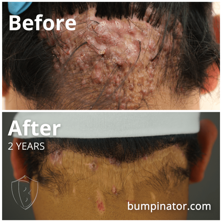 AKN Removal Results Los Angeles: Another Successful Case by The Bumpinator