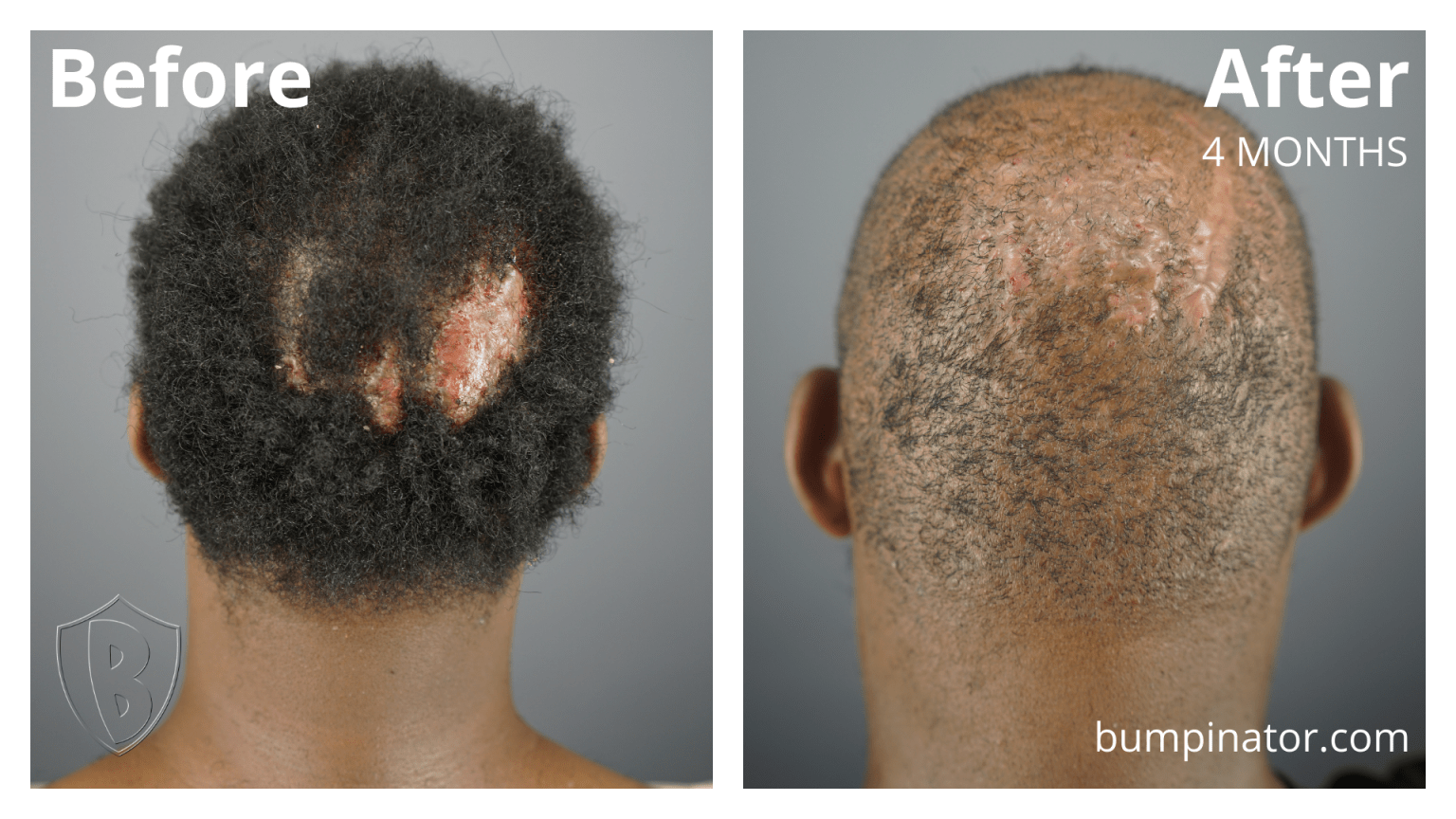 Folliculitis Decalvans Removal: Get Rid of FD Permanently - Bumpinator