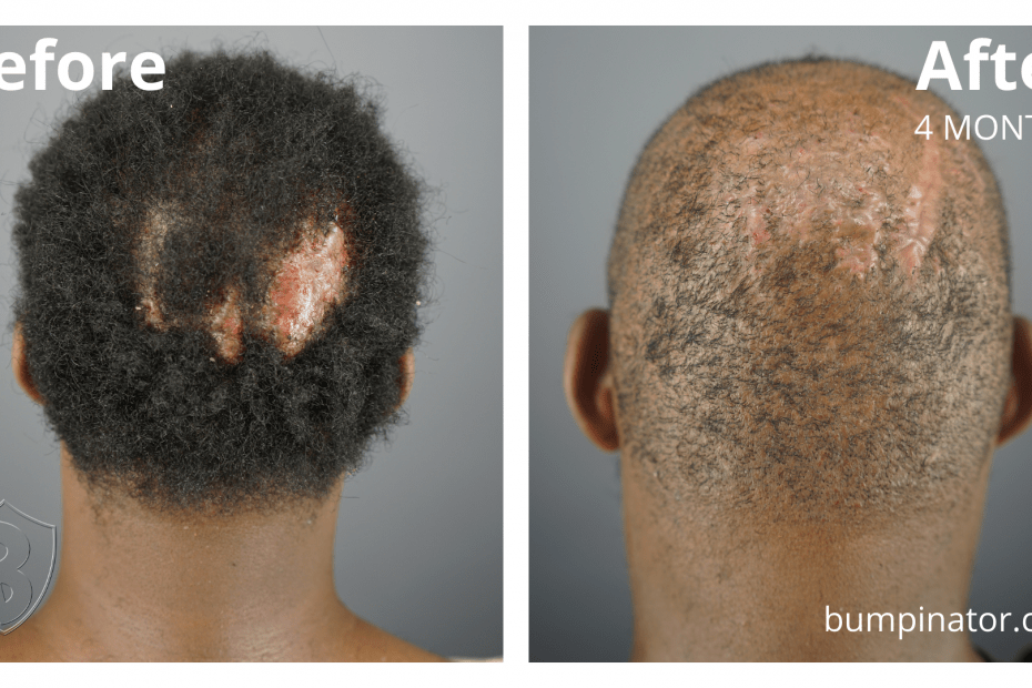 Bumpinator - Folliculitis Decalvans FD Removal Surgery Before and After Results, 4 months post treatment.