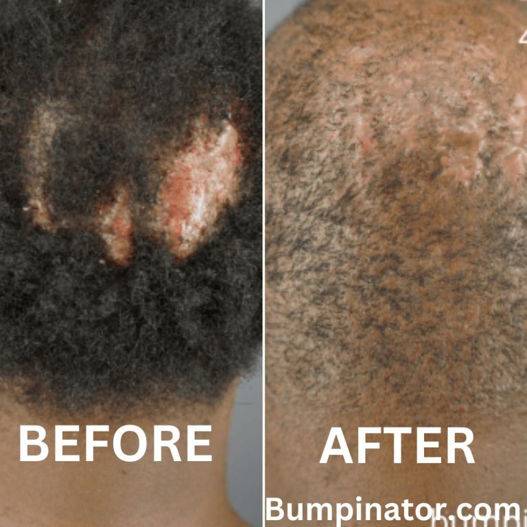 Folliculitis Decalvans Removal: Get Rid of FD Permanently