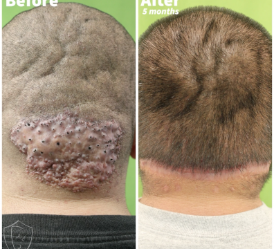 AKN Plaque Removal Before and After Patient Results - Dr. U Skin & Hair Clinic