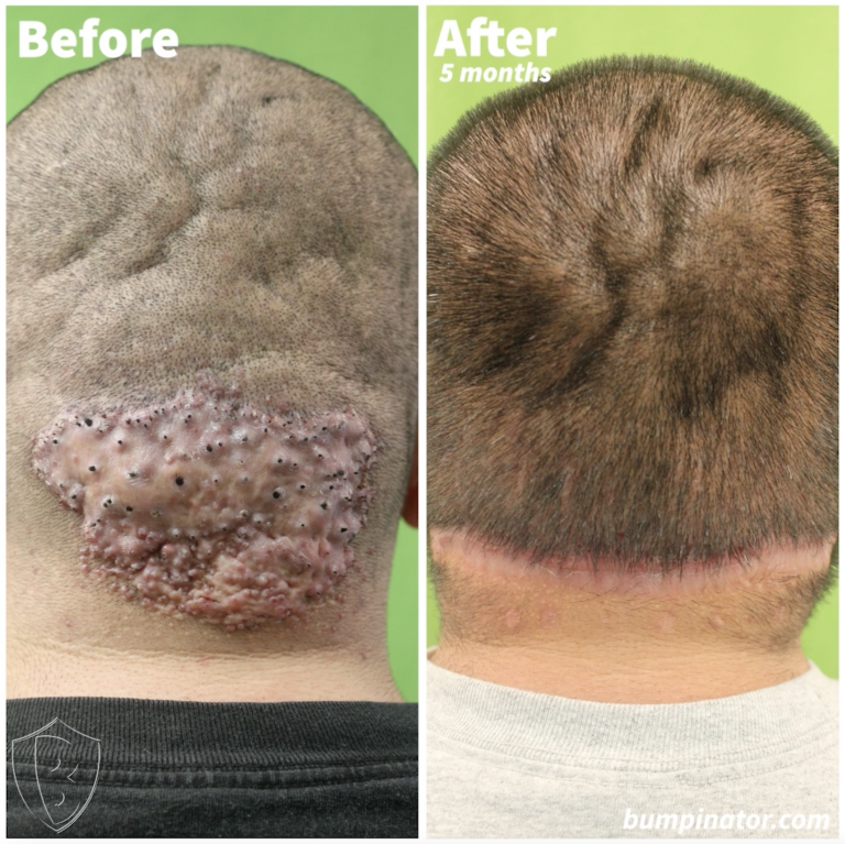 Get Rid of Plaques Behind Back of Head: AKN Plaque Removal Results by The Bumpinator