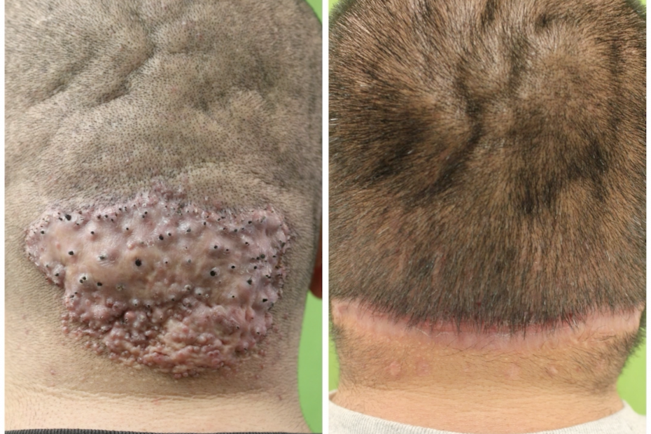 AKN Plaque Removal Before and After Patient Results - Dr. U Skin & Hair Clinic