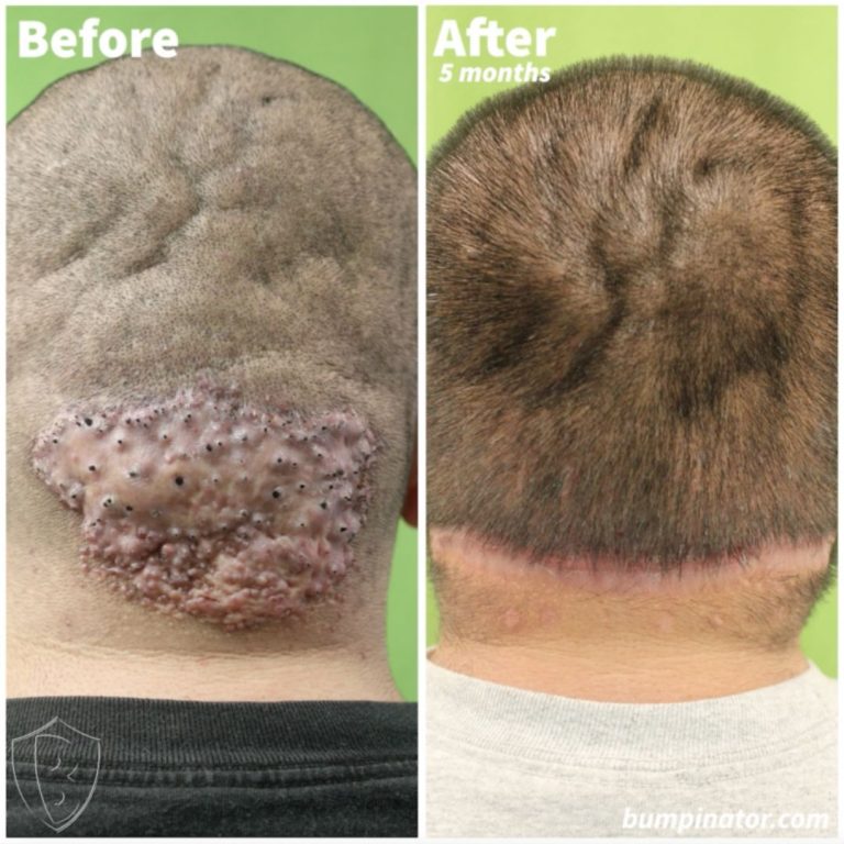 Get Rid of Plaques Behind Back of Head: AKN Plaque Removal Results by The Bumpinator