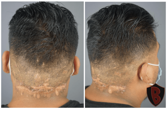 Figure 5 1 year and 8 months after his removal surgery and the scar is healing so well, the patient feels comfortable enough to have a short haircut. *