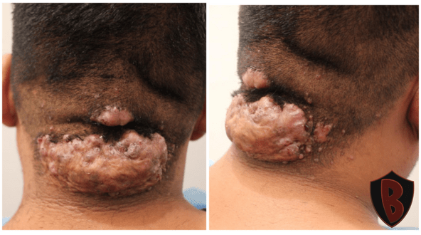 Figure 1 The AKN patient had two lesions and many small bumps, which he wanted to be removed by Dr. Umar. *