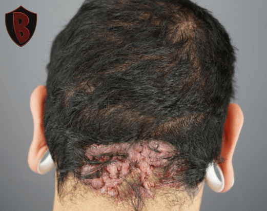 Figure 1 The patient had a large AKN plaque at the nape of his head.*