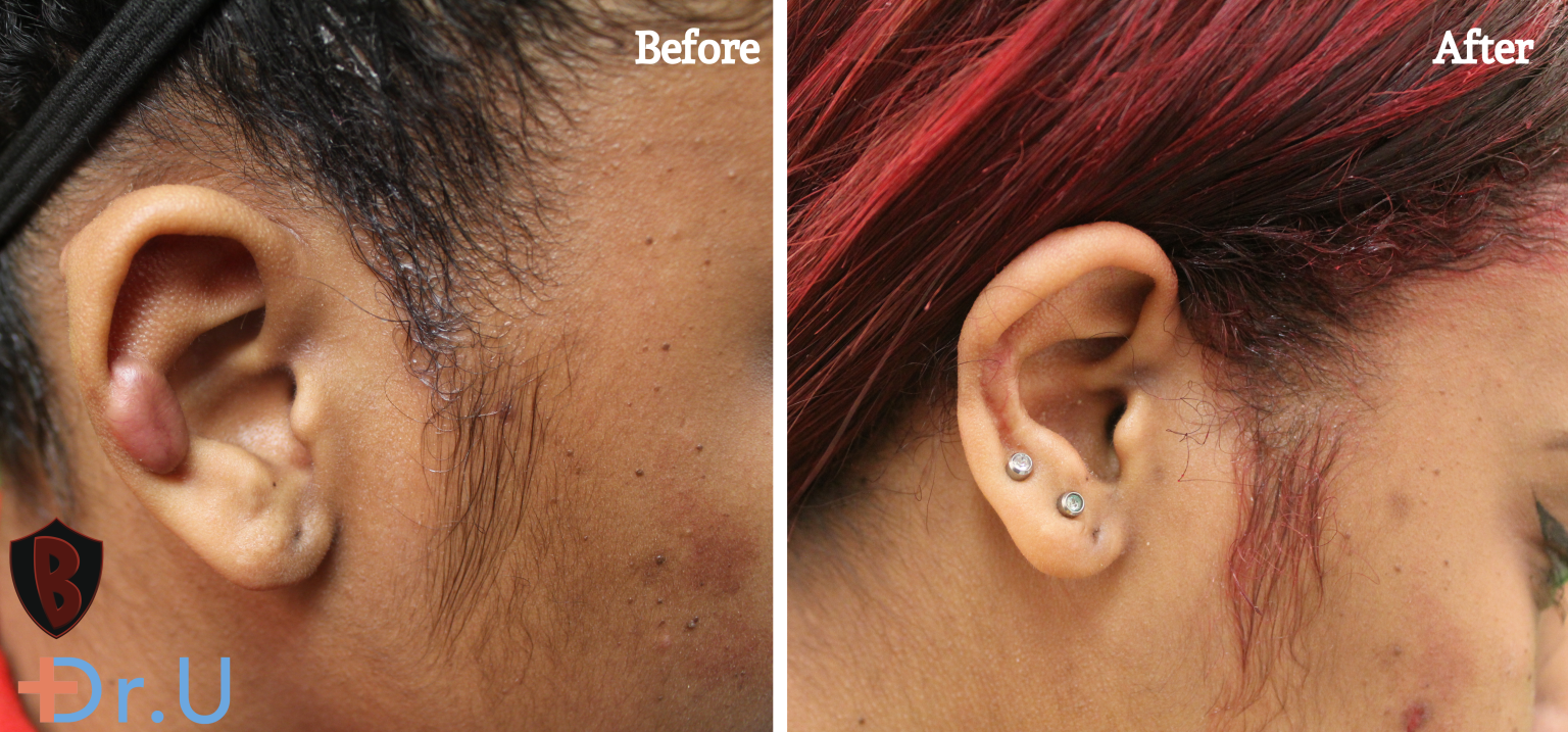 Should You Get a Tattoo if You Have KeloidProne Skin Bumpinator