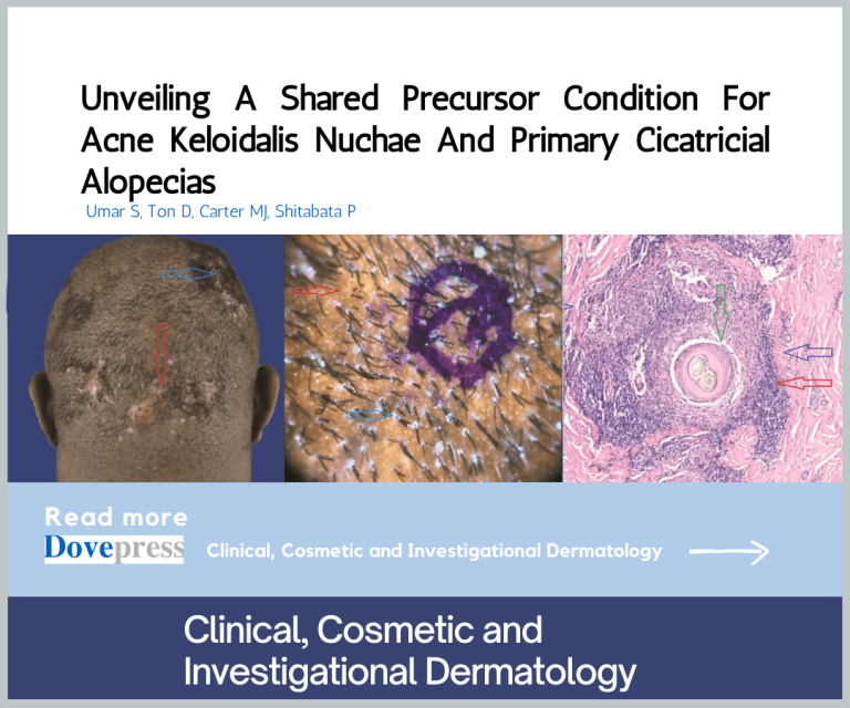 Revealing a Common Precursor Condition in Acne Keloidalis Nuchae and Primary Cicatricial Alopecias
