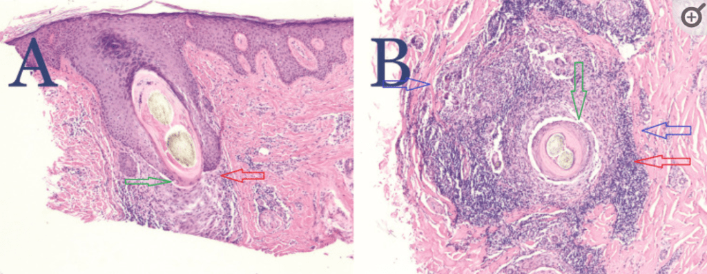 NAS biopsy showing PIILIF (A-vertical biopsy, B-horizontal biopsy).