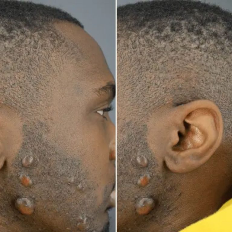 Understanding the Factors that Predispose You to Keloids