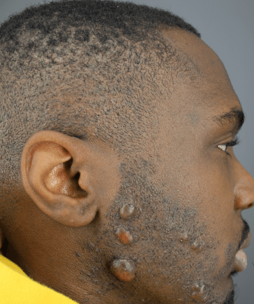 Understanding the Factors that Predispose You to Keloids