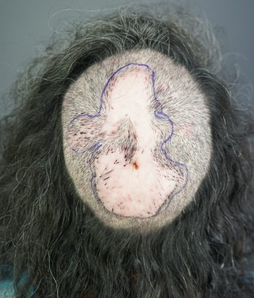 Maria’s scalp lesion kept growing and started oozing puss.