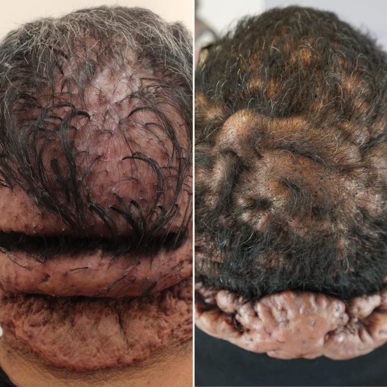 What is Cutis Verticis Gyrata (CVG) or Bulldog Scalp Syndrome?
