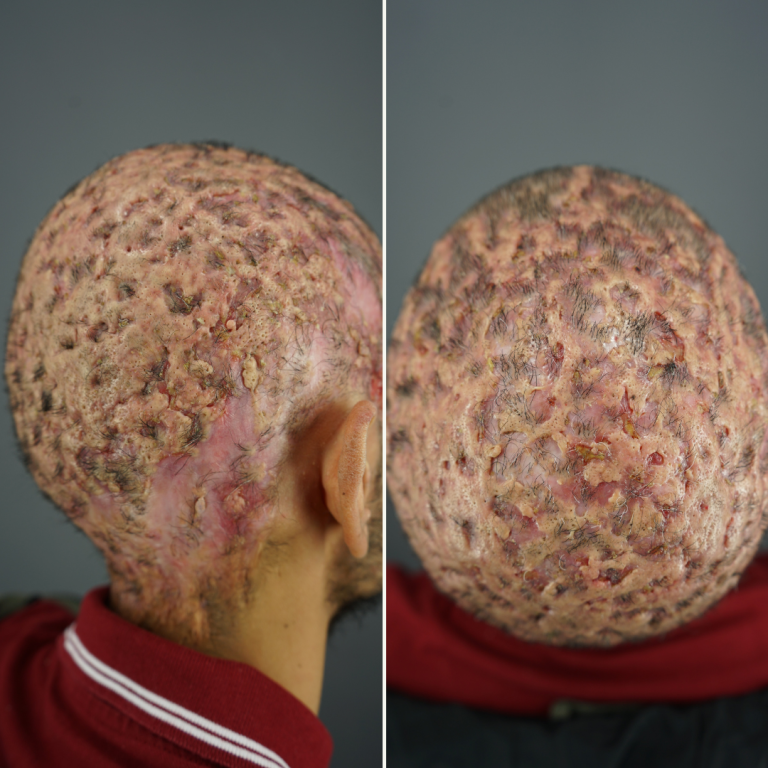 What is Dissecting Cellulitis?