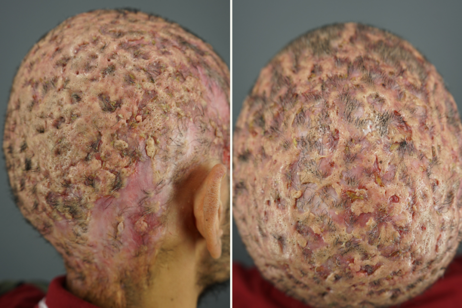 A patient with a very severe case of dissecting cellulitis. He is currently receiving laser treatment under the care of Dr. Umar to manage symptoms.