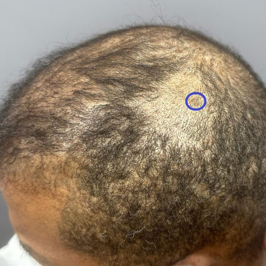 A patient with PIILIF during a biopsy examination by Dr. Umar.