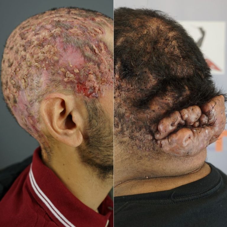 Dissecting Cellulitis Treatment