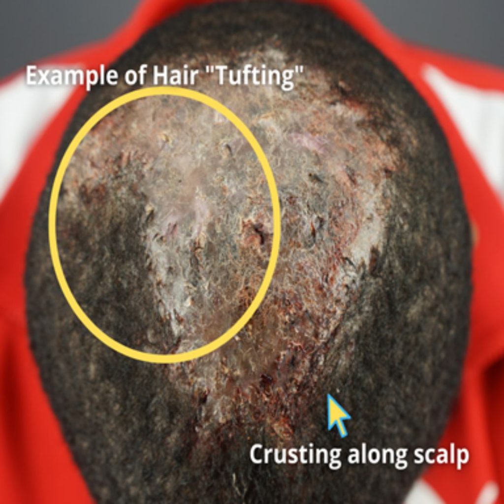 An illustration of hair ‘tufting’ and crusting scalp on a patient with severe Folliculitis Decalvans (FD).